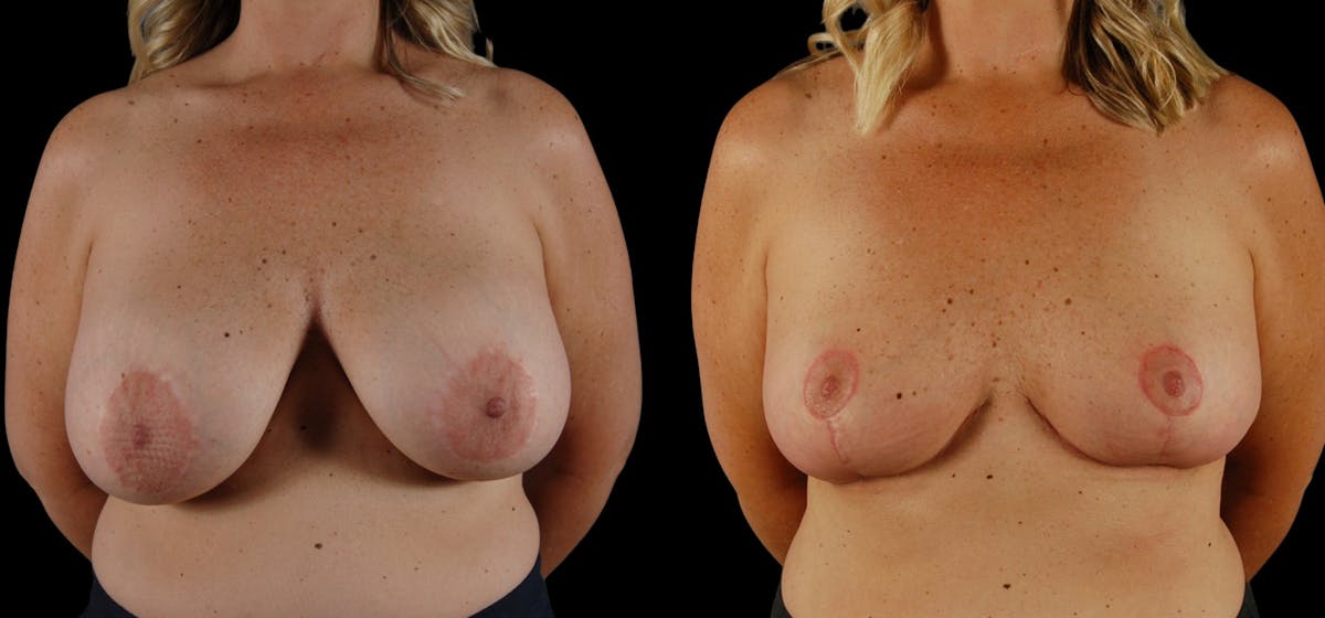 Breast Implant Removal Before & After Gallery - Patient 158908 - Image 2