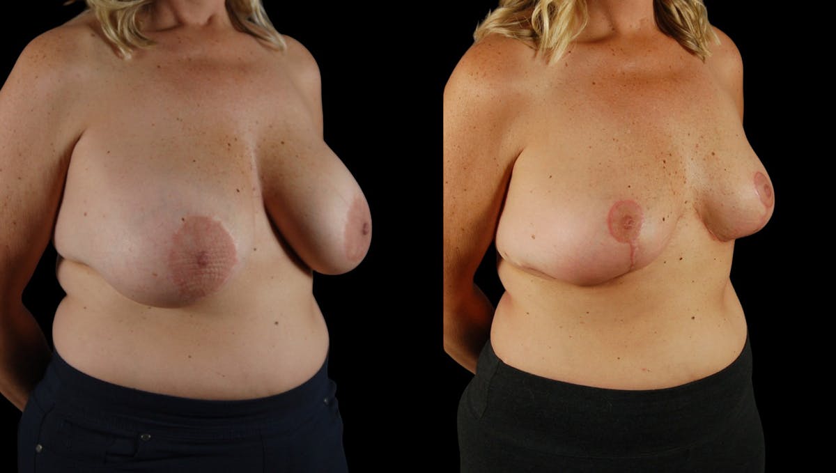 Breast Implant Removal Before & After Gallery - Patient 158908 - Image 5