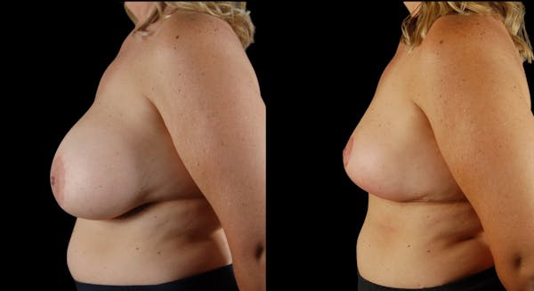 Breast Implant Removal Before & After Gallery - Patient 158908 - Image 1