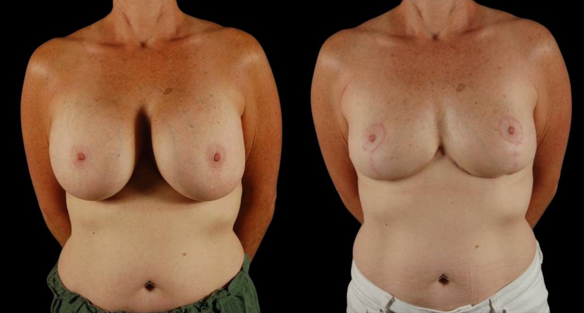 Breast Implant Removal Before & After Gallery - Patient 197683 - Image 2