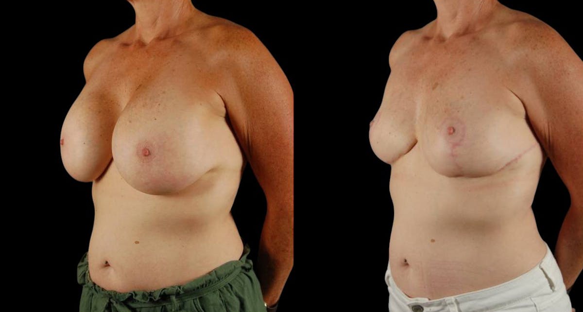 Breast Implant Removal Before & After Gallery - Patient 197683 - Image 3