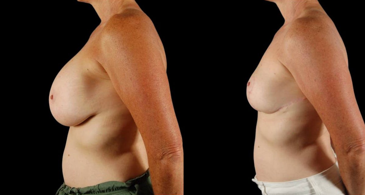 Breast Implant Removal Before & After Gallery - Patient 197683 - Image 1