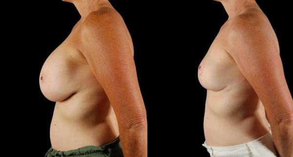 Breast Implant Removal Before & After Gallery - Patient 197683 - Image 1