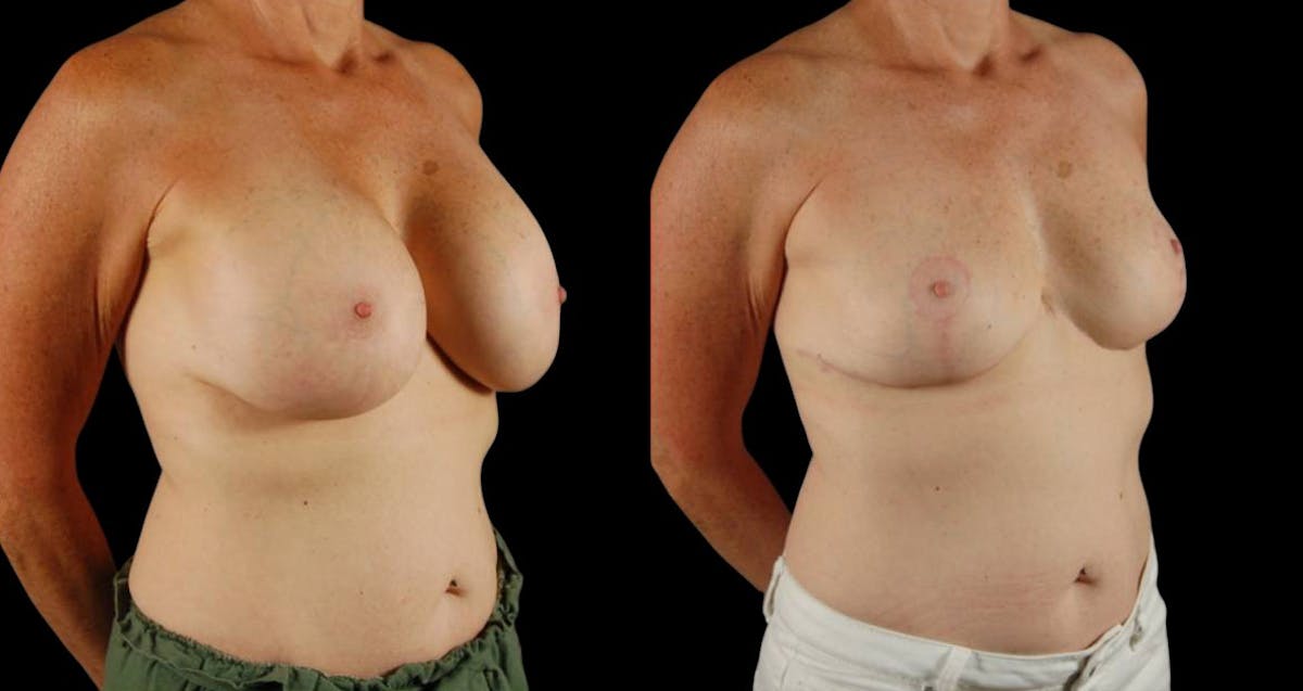 Breast Implant Removal Before & After Gallery - Patient 197683 - Image 4