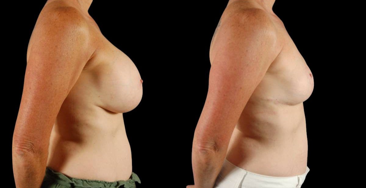 Breast Implant Removal Before & After Gallery - Patient 197683 - Image 5