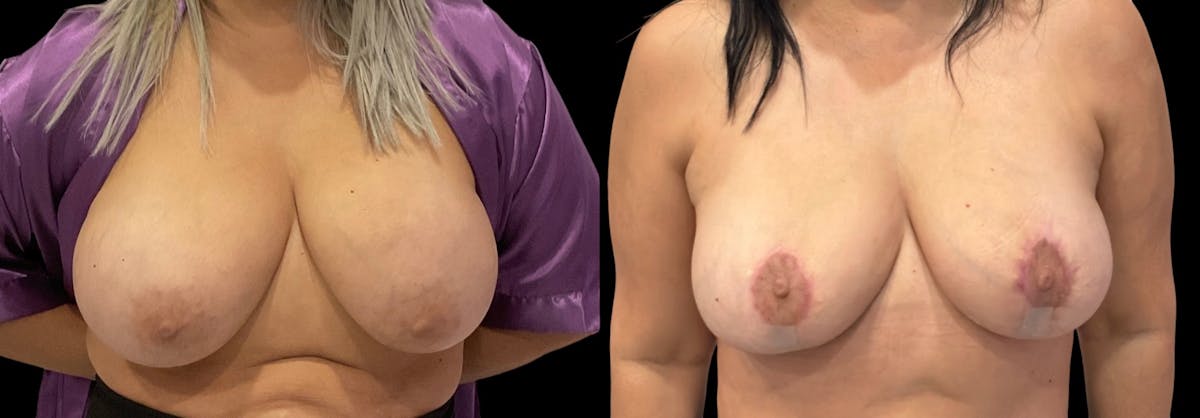 Breast Implant Removal Before & After Gallery - Patient 383729 - Image 2