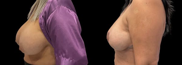 Breast Implant Removal Before & After Gallery - Patient 383729 - Image 1