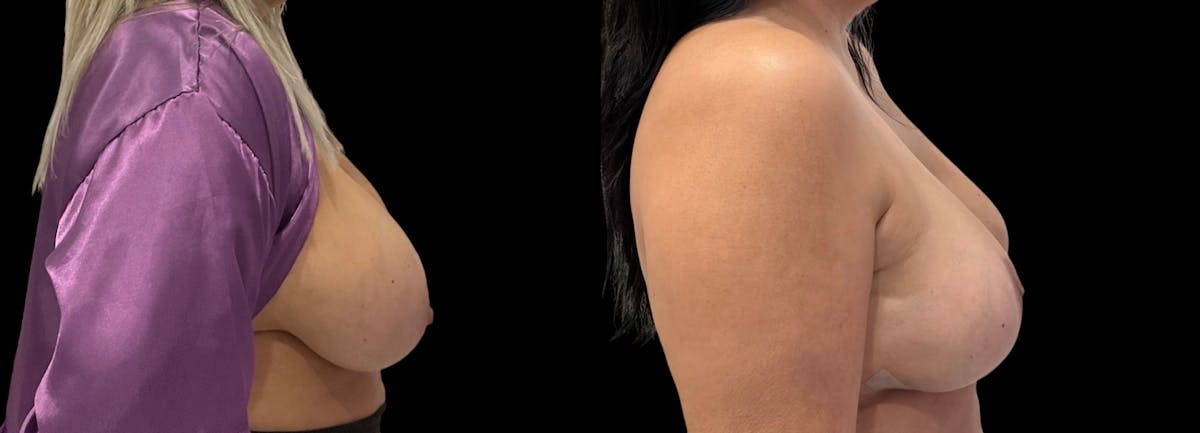 Breast Implant Removal Before & After Gallery - Patient 383729 - Image 4