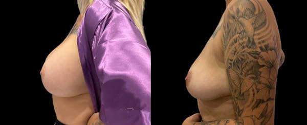 Breast Implant Removal Before & After Gallery - Patient 578966 - Image 1