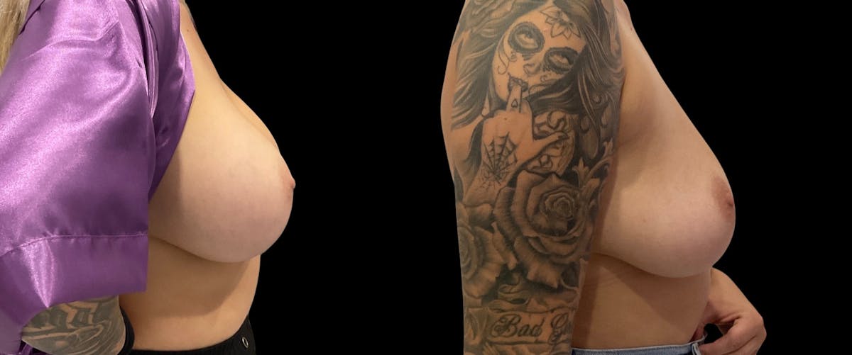 Breast Implant Removal Before & After Gallery - Patient 578966 - Image 2