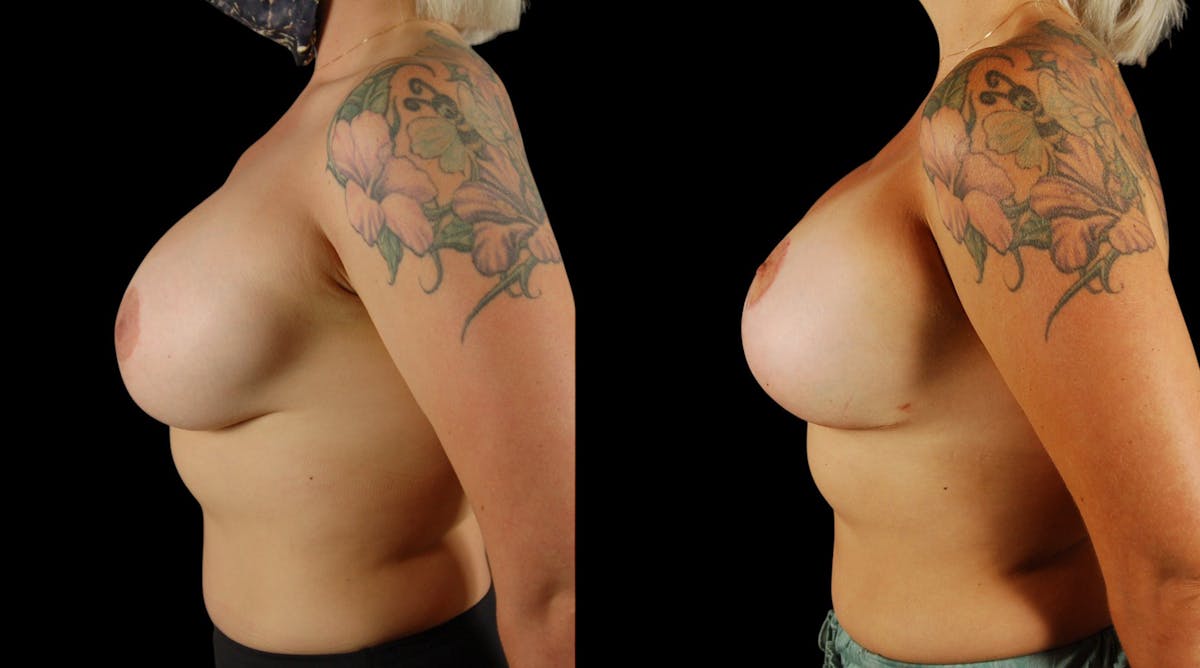 Breast Implant Revision Before & After Gallery - Patient 141740 - Image 2
