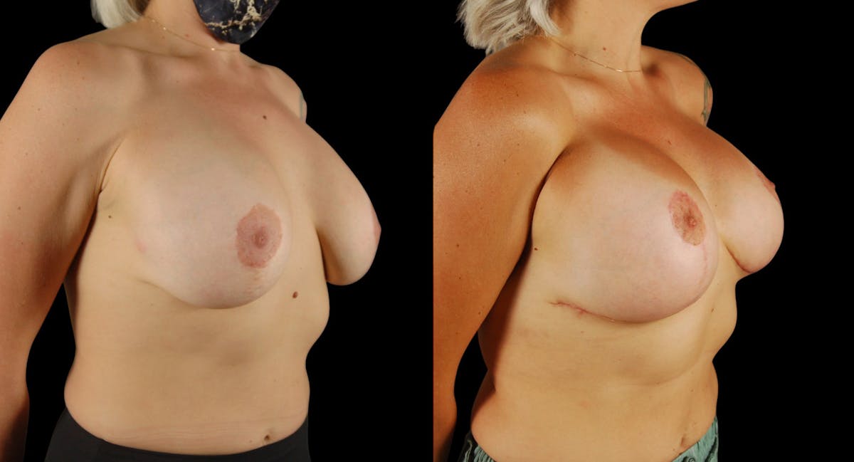 Breast Implant Revision Before & After Gallery - Patient 141740 - Image 5