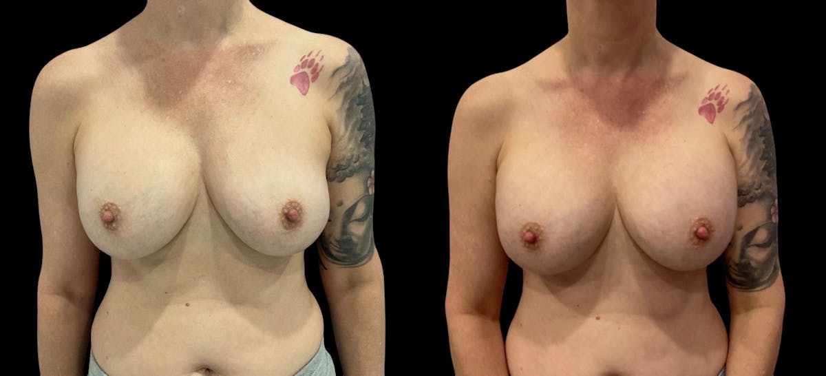 Breast Implant Revision Before & After Gallery - Patient 441321 - Image 2