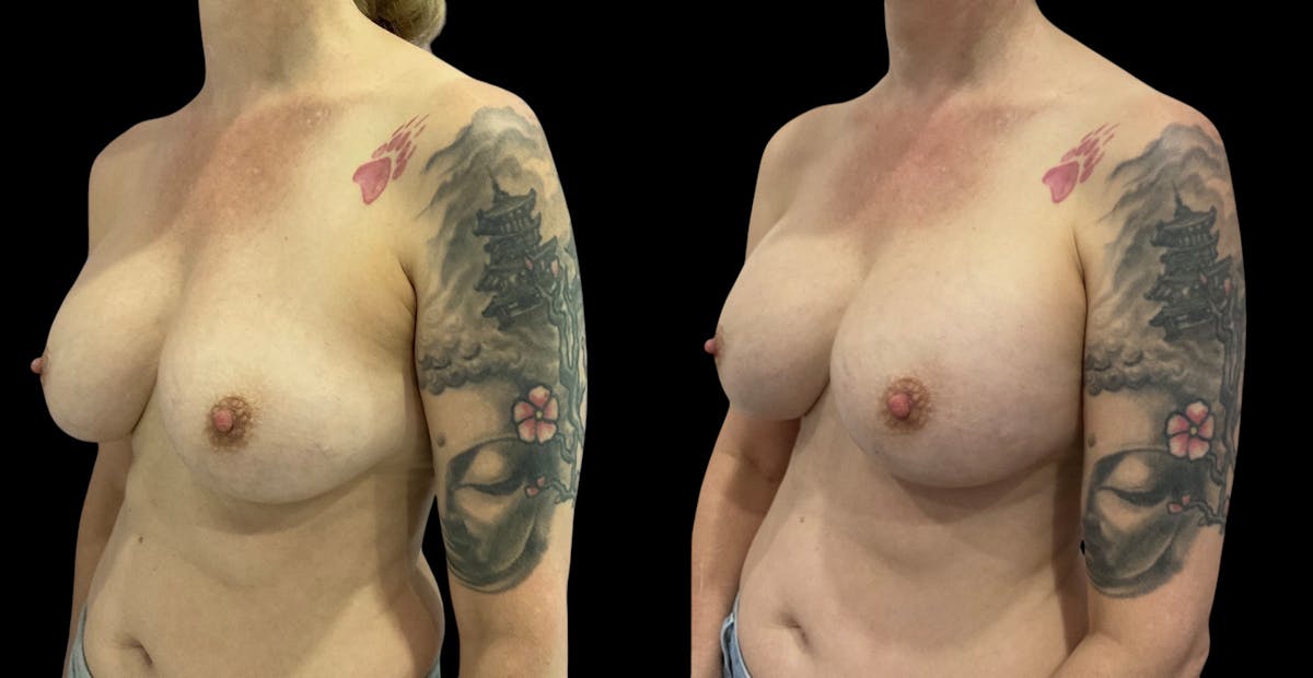 Breast Implant Revision Before & After Gallery - Patient 441321 - Image 1