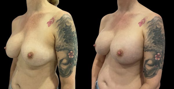 Breast Implant Revision Before & After Gallery - Patient 441321 - Image 1