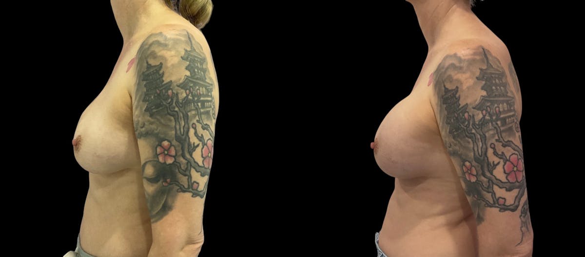 Breast Implant Revision Before & After Gallery - Patient 441321 - Image 3
