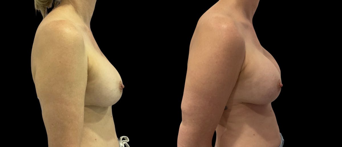 Breast Implant Revision Before & After Gallery - Patient 441321 - Image 4