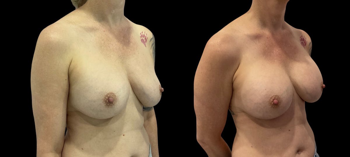 Breast Implant Revision Before & After Gallery - Patient 441321 - Image 5