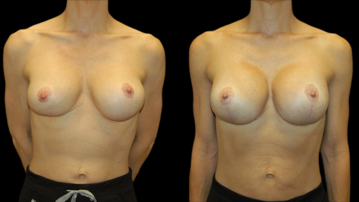 Breast Lift with Implants Before & After Gallery - Patient 369979 - Image 1