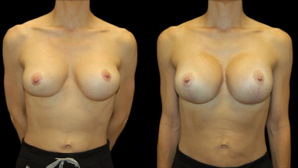 Breast Lift with Implants Before & After Gallery - Patient 369979 - Image 1
