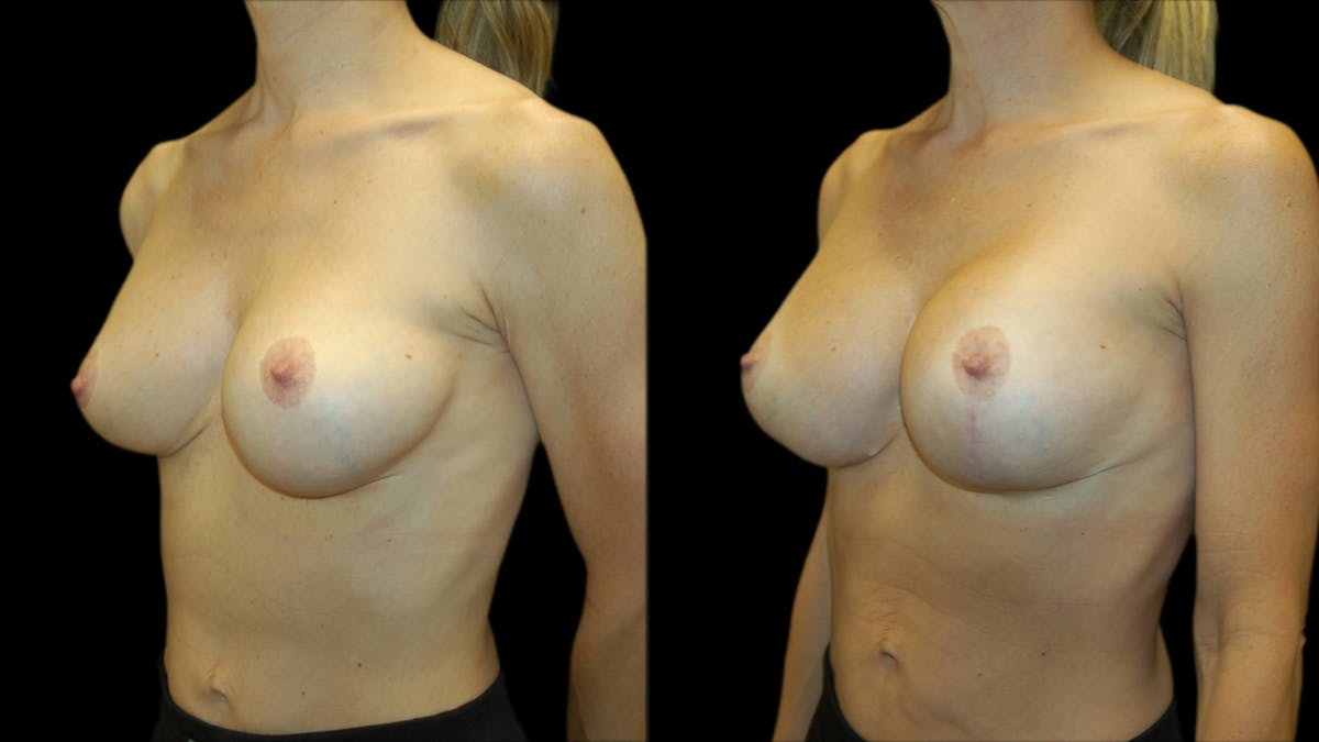 Breast Lift with Implants Before & After Gallery - Patient 369979 - Image 2
