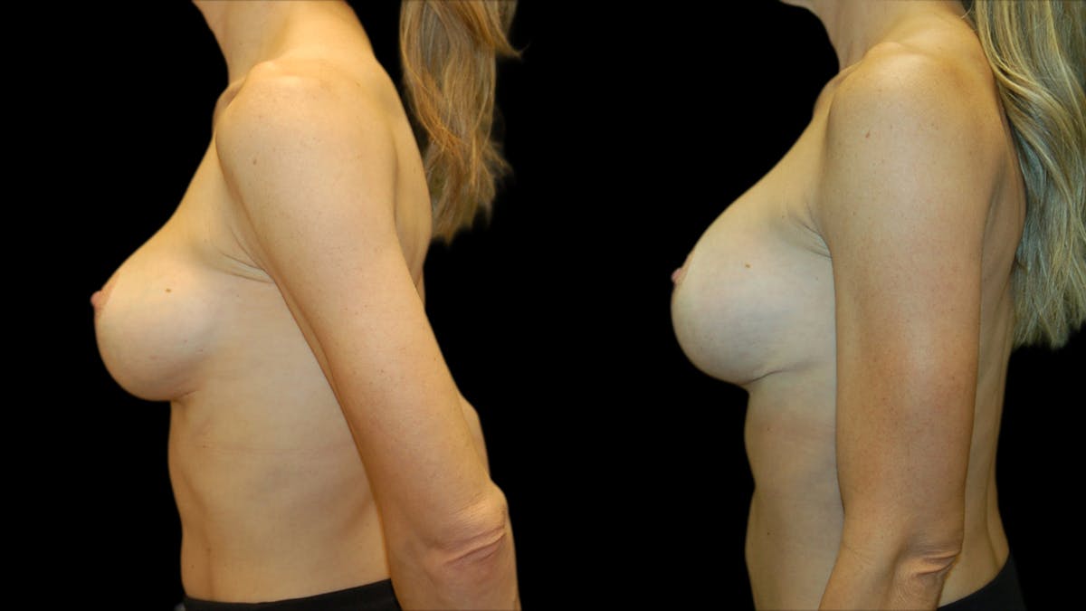 Breast Lift with Implants Before & After Gallery - Patient 369979 - Image 3