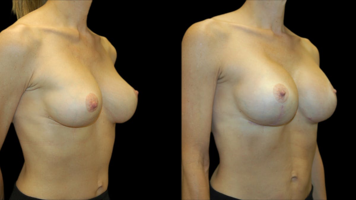 Breast Lift with Implants Before & After Gallery - Patient 369979 - Image 4