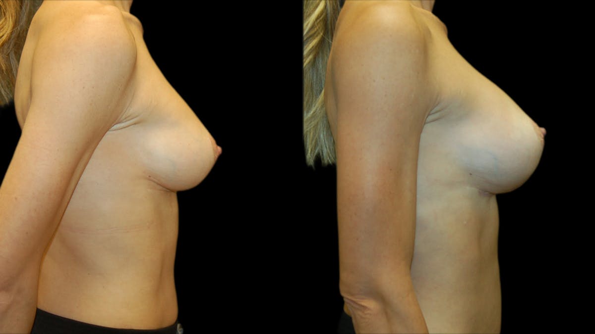 Breast Lift with Implants Before & After Gallery - Patient 369979 - Image 5