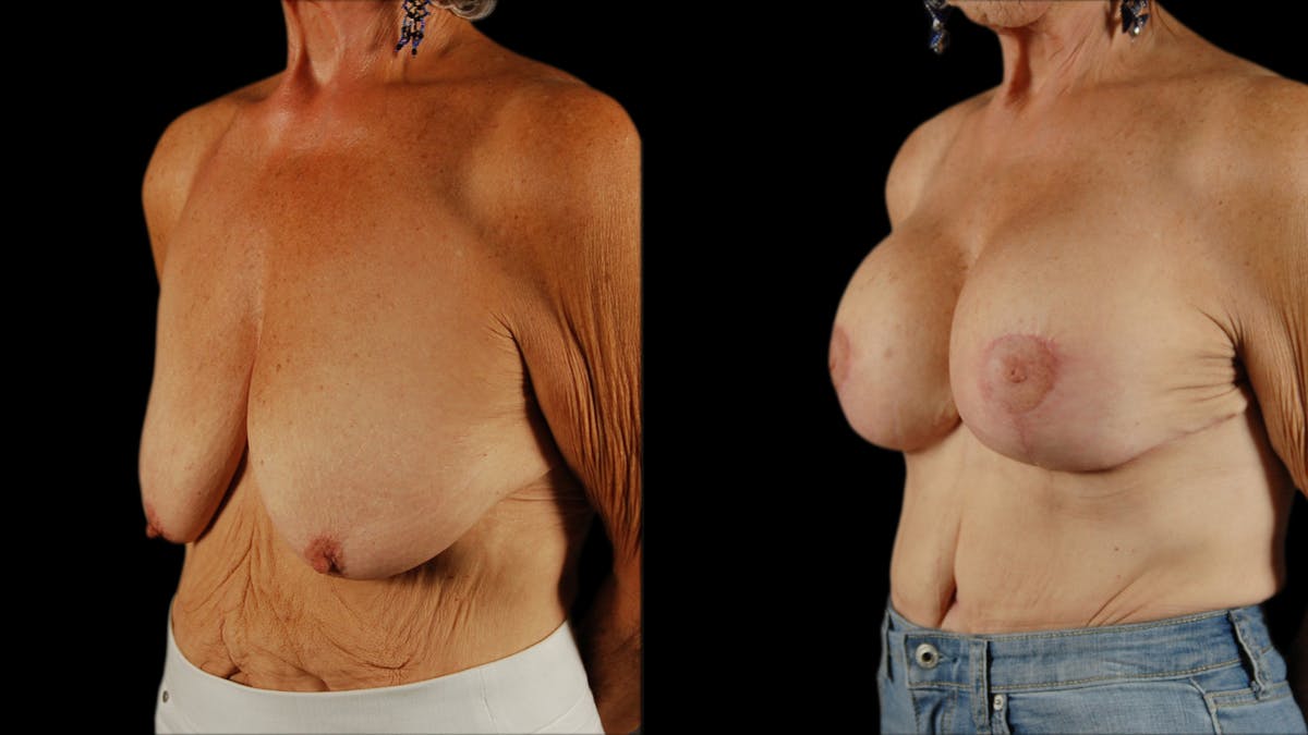 Breast Lift with Implants Before & After Gallery - Patient 386342 - Image 2