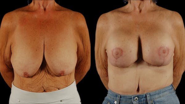 Breast Lift with Implants Before & After Gallery - Patient 386342 - Image 1
