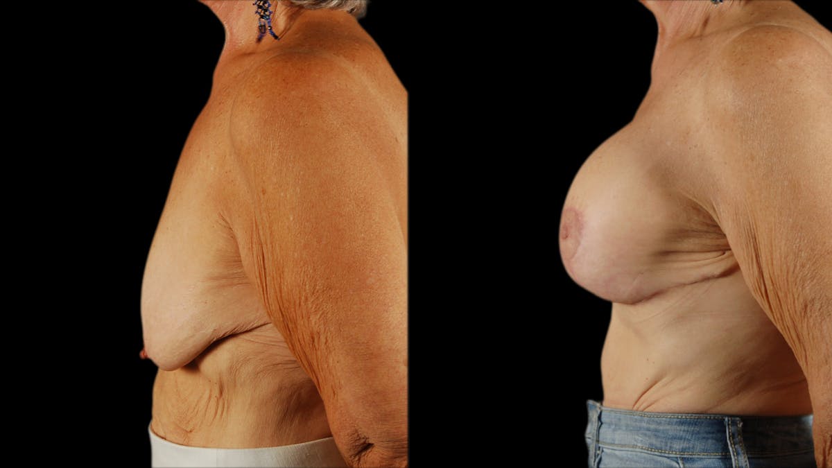 Breast Lift with Implants Before & After Gallery - Patient 386342 - Image 3