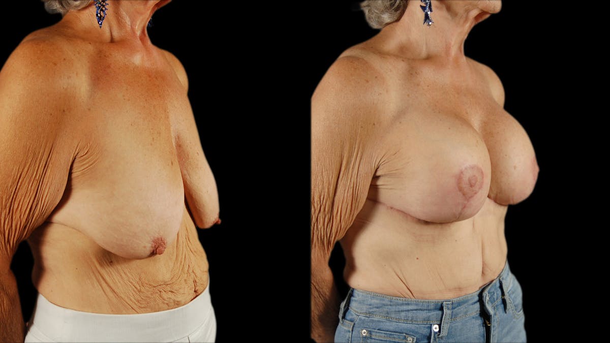 Breast Lift with Implants Before & After Gallery - Patient 386342 - Image 4