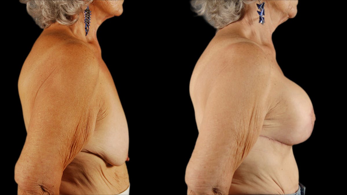 Breast Lift with Implants Before & After Gallery - Patient 386342 - Image 5