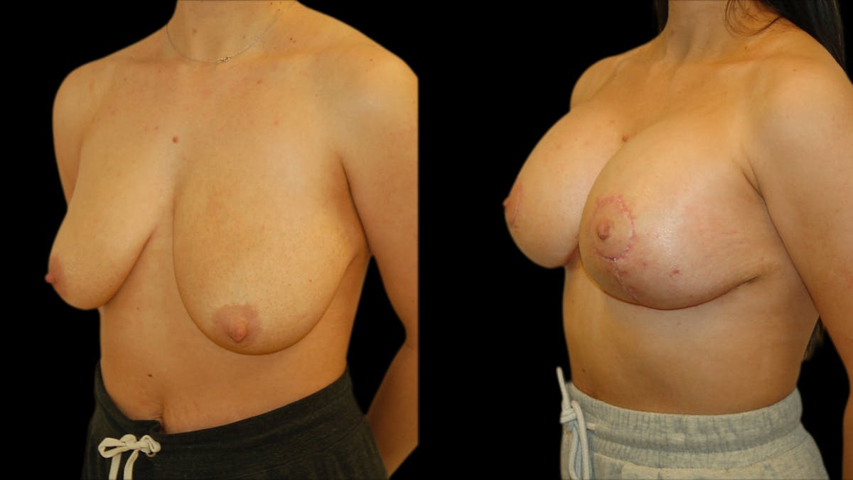Breast Lift with Implants Before & After Gallery - Patient 123831 - Image 2
