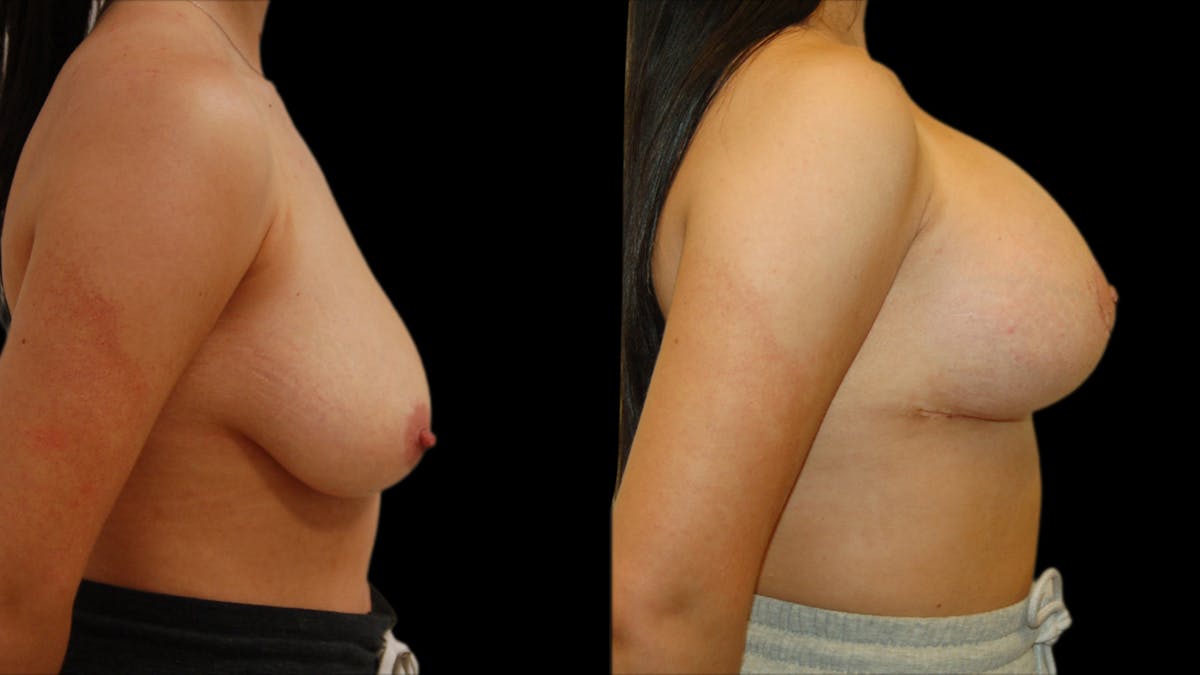 Breast Lift with Implants Before & After Gallery - Patient 123831 - Image 3