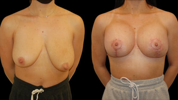 Breast Lift with Implants Before & After Gallery - Patient 123831 - Image 1