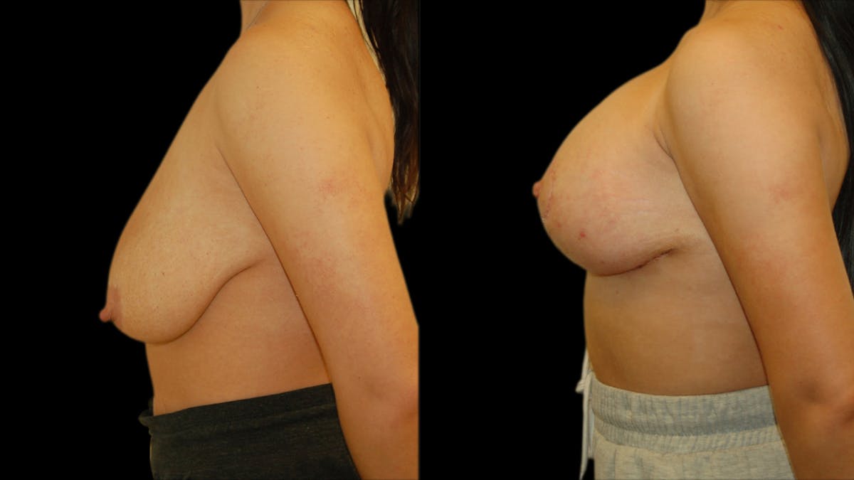 Breast Lift with Implants Before & After Gallery - Patient 123831 - Image 4