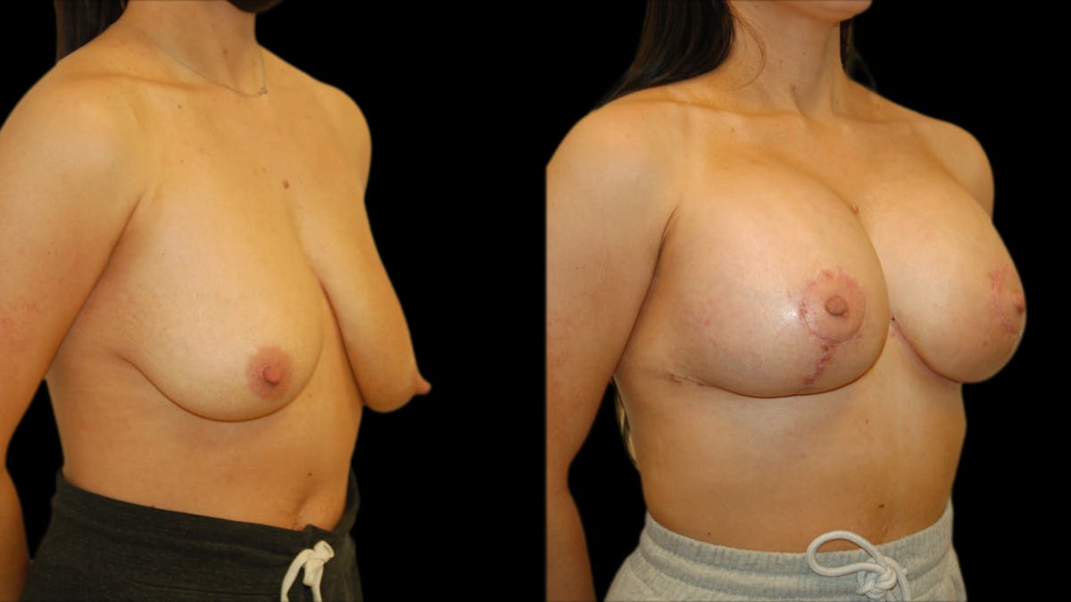 Breast Lift with Implants Before & After Gallery - Patient 123831 - Image 5