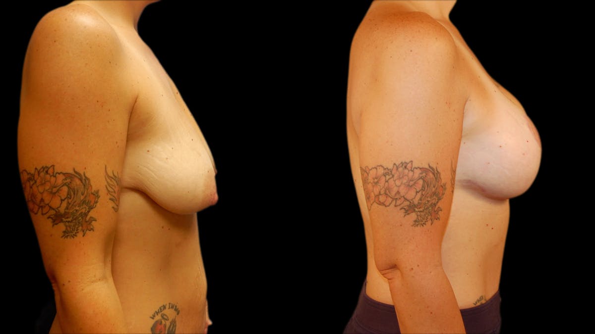 Breast Lift with Implants Before & After Gallery - Patient 360825 - Image 2