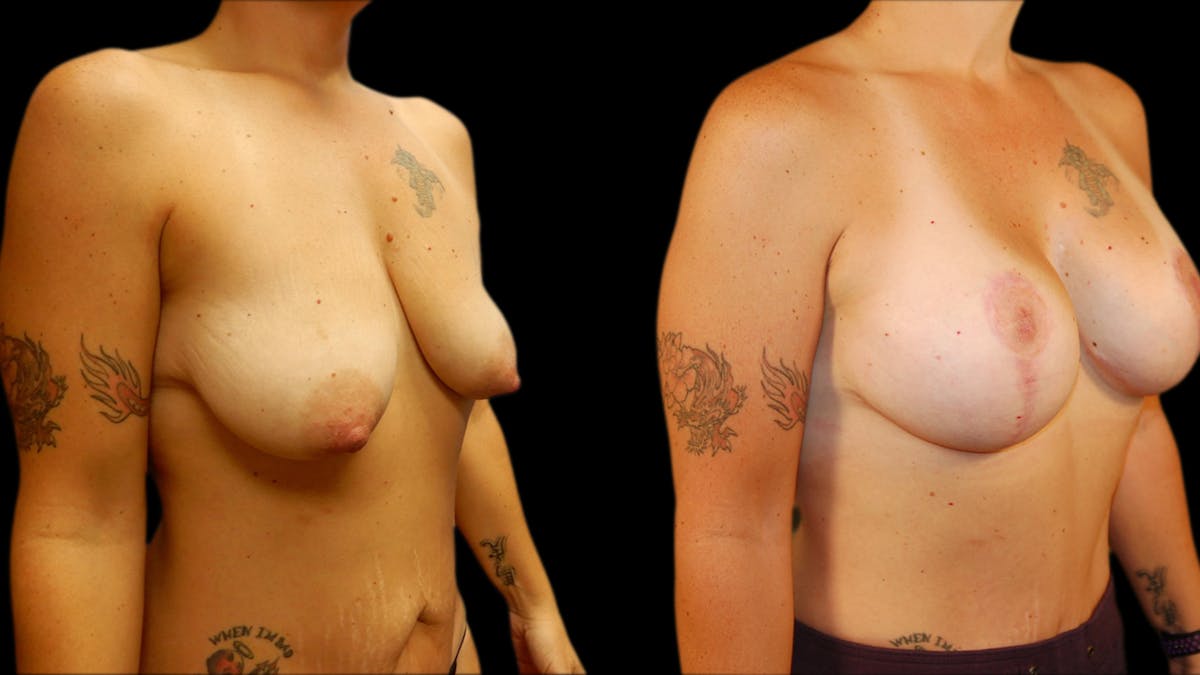 Breast Lift with Implants Before & After Gallery - Patient 360825 - Image 3