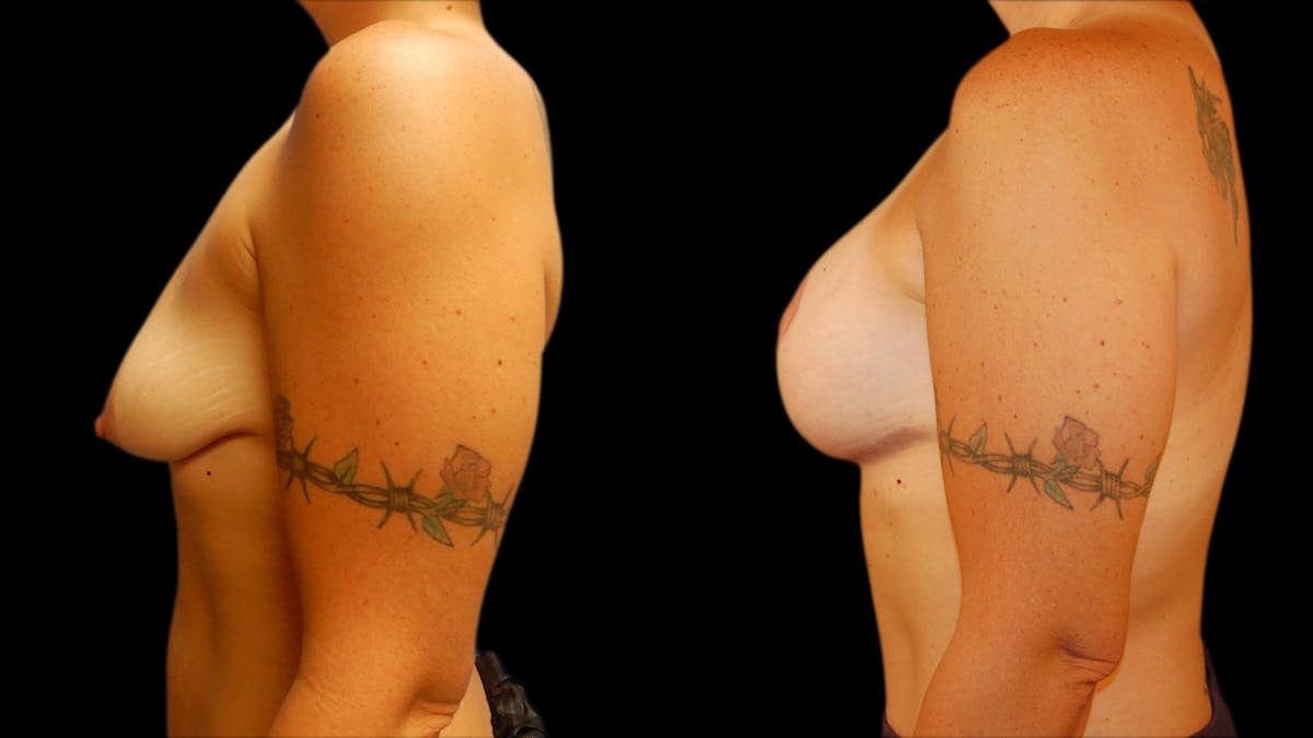 Breast Lift with Implants Before & After Gallery - Patient 360825 - Image 5
