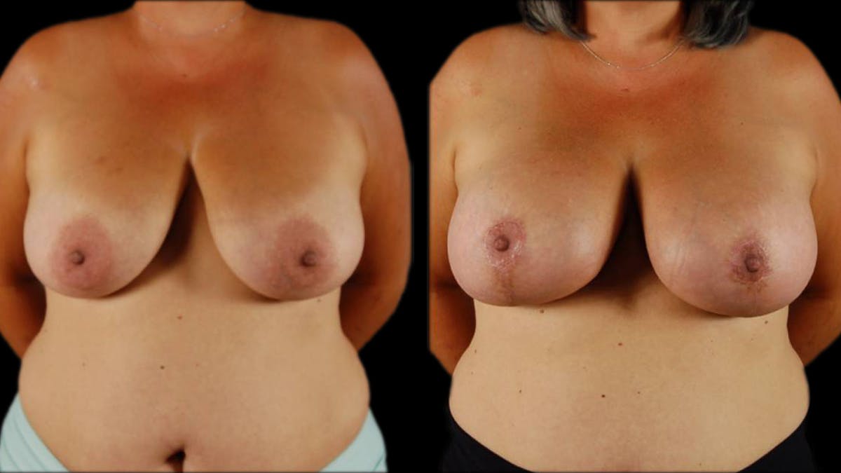 Breast Lift with Implants Before & After Gallery - Patient 134526 - Image 1