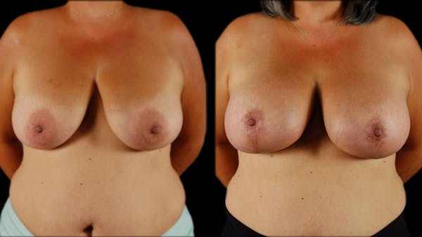 Breast Lift with Implants Before & After Gallery - Patient 134526 - Image 1