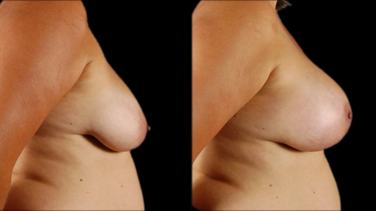 Breast Lift with Implants Before & After Gallery - Patient 134526 - Image 3