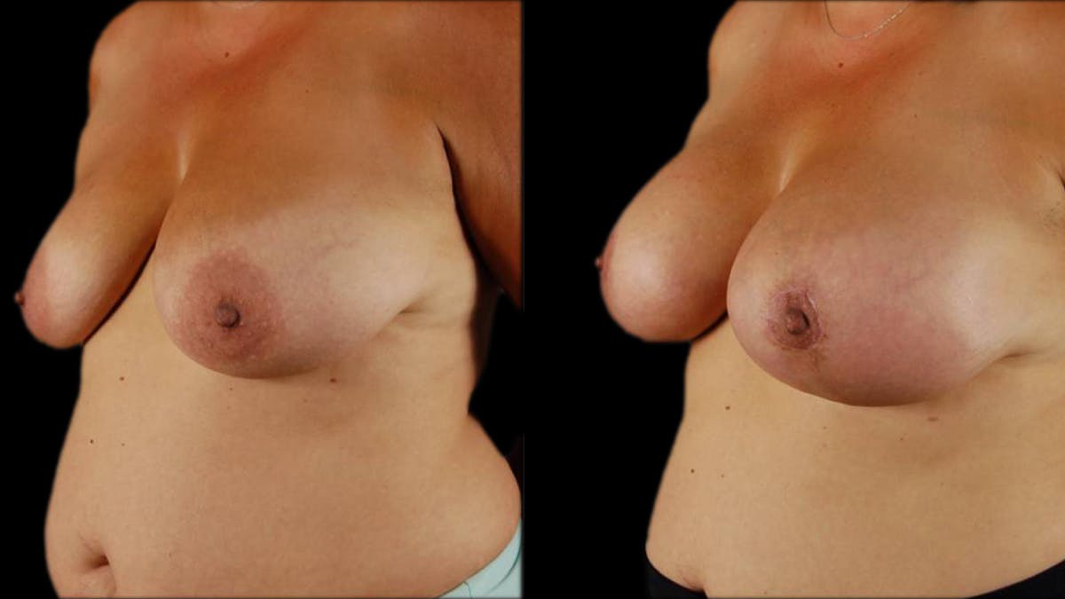 Breast Lift with Implants Before & After Gallery - Patient 134526 - Image 4