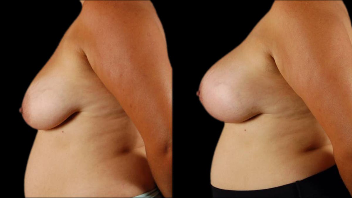 Breast Lift with Implants Before & After Gallery - Patient 134526 - Image 5