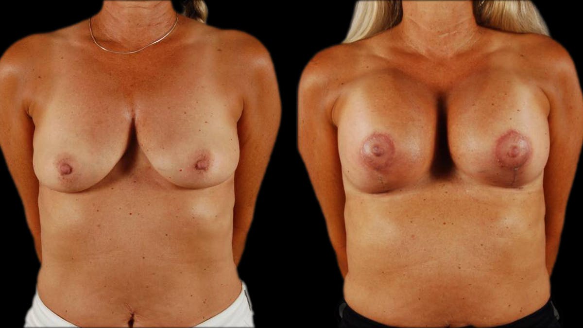 Breast Lift with Implants Before & After Gallery - Patient 999078 - Image 1