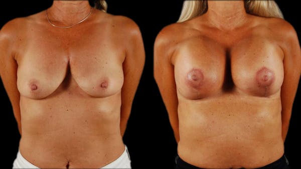Breast Lift with Implants Before & After Gallery - Patient 999078 - Image 1