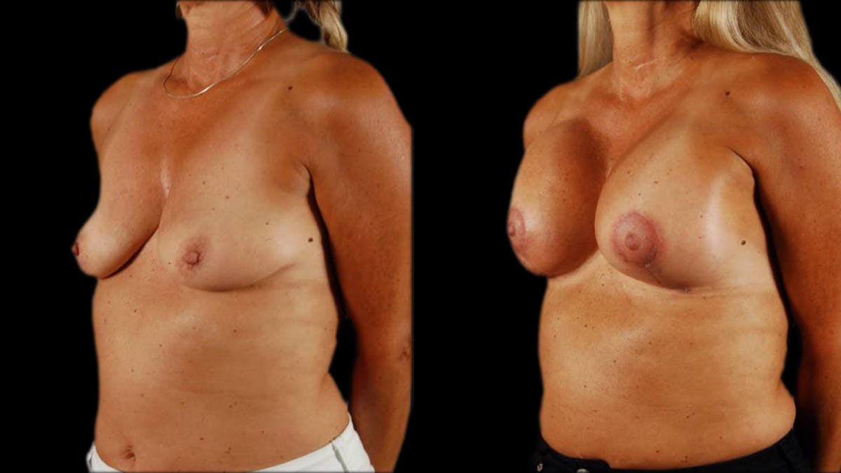 Breast Lift with Implants Before & After Gallery - Patient 999078 - Image 2