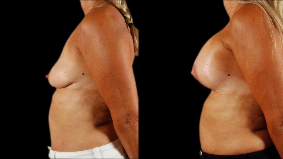 Breast Lift with Implants Before & After Gallery - Patient 999078 - Image 3